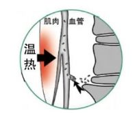 可喜安电位温热治疗仪与温热疗法