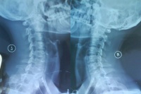 加班族“职业病”悄悄加剧，SKG让你不再“年纪轻轻颈椎却老了”